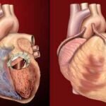 9 rare heart diseases